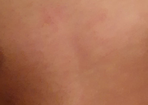 Inflammation and Hospitalisation image
