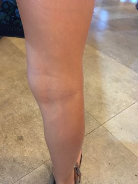 Inflammation and Hospitalisation image