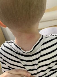 Inflammation and Hospitalisation image