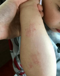 Inflammation and Hospitalisation image