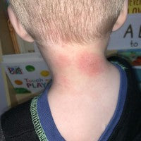 Inflammation and Hospitalisation image