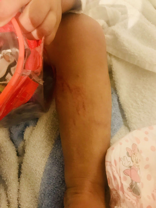 Inflammation and Hospitalisation image
