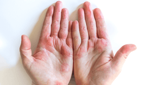 Eczema Relief without Steroids: