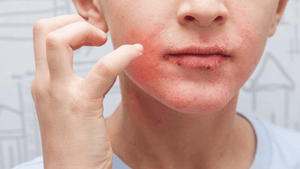 Home Tips to Manage Eczema