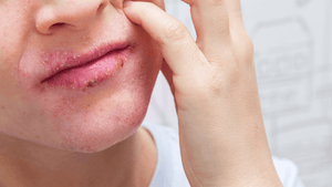 Mouth Eczema, Lip Eczema Treatment
