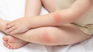 A Gentle Approach to Baby Eczema Treatment