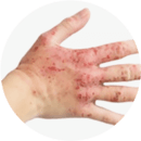 files/Red_sore_itchy_hands_-_Level_2_Calm_Clear_Cream.png