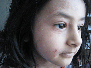 Inflammation and Hospitalisation image