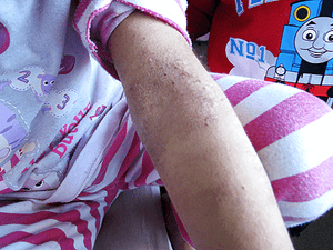 Inflammation and Hospitalisation image