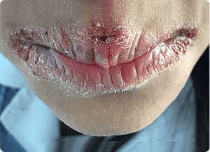 Inflammation and Hospitalisation image