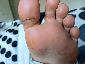 Inflammation and Hospitalisation image